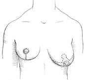 mastopexy/breast reduction