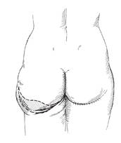 buttock lift